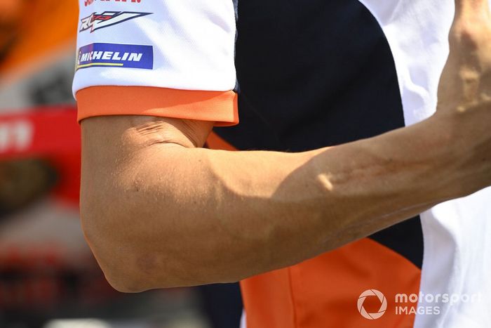 Detalle del brazo de Marc Márquez, Repsol Honda Team